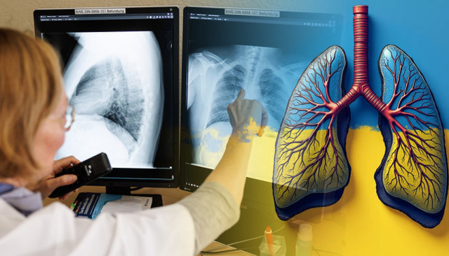 У Рівному обговорили нові кроки міжнародного проєкту протидії туберкульозу